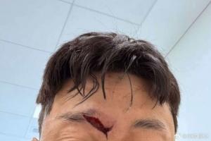 慎入!高准翼眉骨处裂开一道大口子,比赛中头部相撞赛后已缝针 - 资讯配图