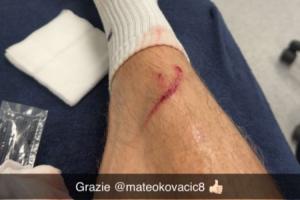 误伤自己人！哈兰德晒照：训练中小腿被科瓦契奇踢出一道血痕 - 资讯配图