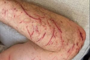 55岁希勒骑自行车时受伤：手臂、腿部多处割伤和擦伤 - 资讯配图